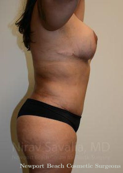 Mastectomy Reconstruction Revision Before & After Gallery - Patient 1655660 - After