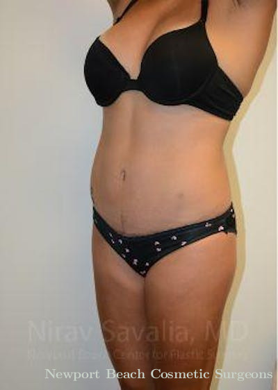 Liposuction Before & After Gallery - Patient 1655662 - After