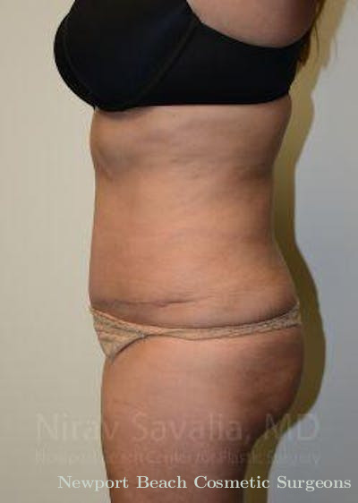 Mastectomy Reconstruction Before & After Gallery - Patient 1655664 - After