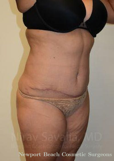 Mastectomy Reconstruction Revision Before & After Gallery - Patient 1655664 - After