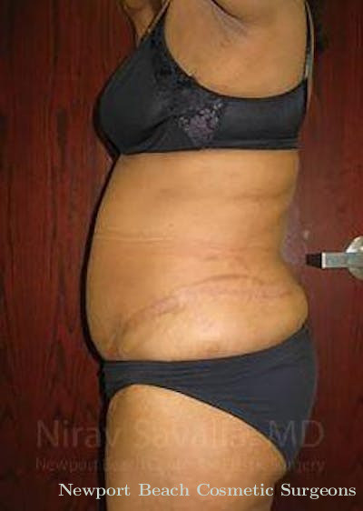 Abdominoplasty Tummy Tuck Before & After Gallery - Patient 1655665 - After