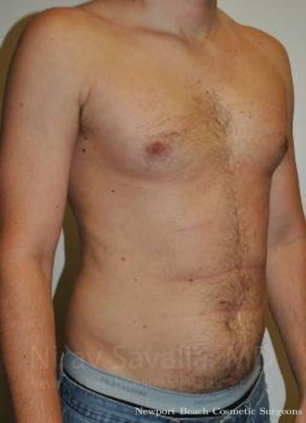 Mastectomy Reconstruction Revision Before & After Gallery - Patient 1655667 - Before