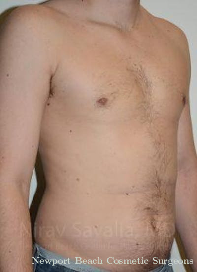 Mastectomy Reconstruction Revision Before & After Gallery - Patient 1655667 - After