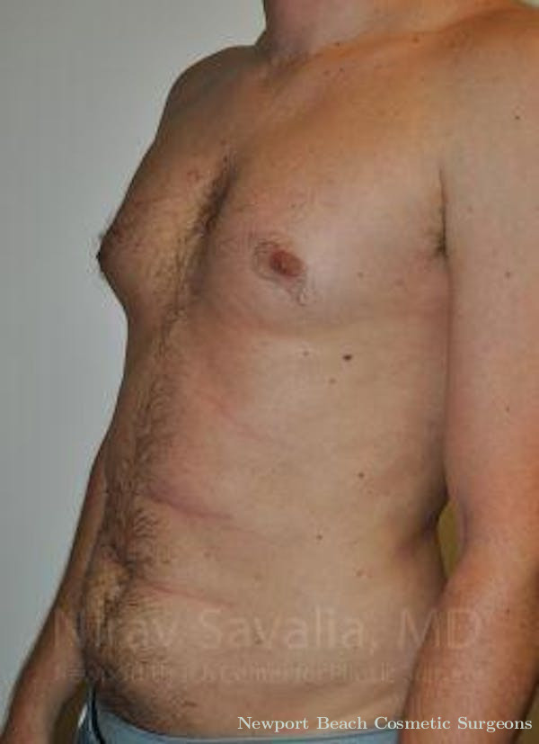Male Breast Reduction Before & After Gallery - Patient 1655667 - Before