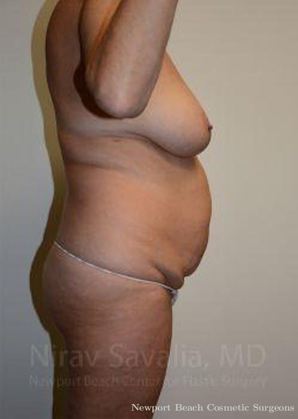 Mastectomy Reconstruction Revision Before & After Gallery - Patient 1655668 - Before
