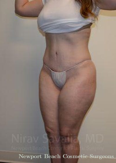 Mastectomy Reconstruction Revision Before & After Gallery - Patient 1655670 - After