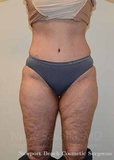 Thigh Lift Before & After Gallery - Patient 1655672 - After