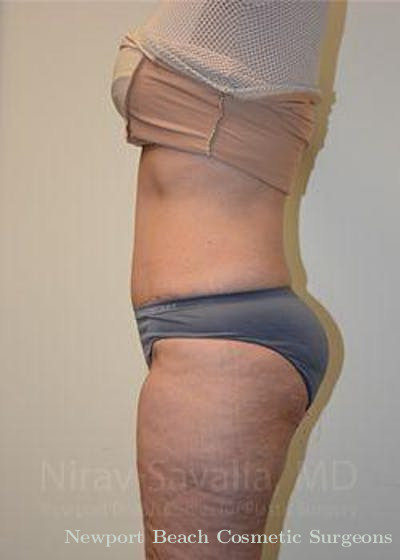 Mastectomy Reconstruction Revision Before & After Gallery - Patient 1655672 - After