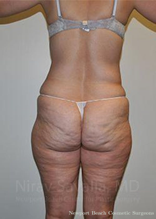 Thigh Lift Before & After Gallery - Patient 1655672 - Before