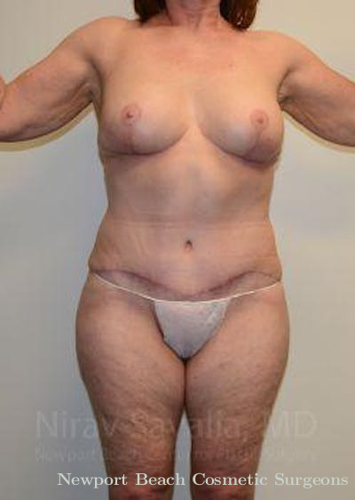 Mastectomy Reconstruction Revision Before & After Gallery - Patient 1655673 - After
