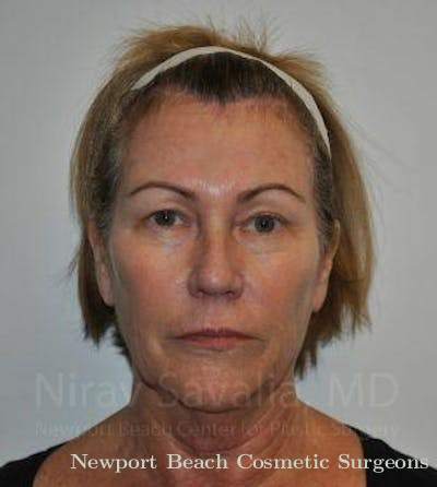Brow Lift Before & After Gallery - Patient 1655680 - Before