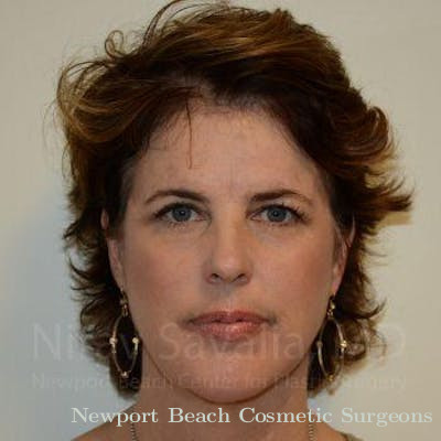 Eyelid Surgery Before & After Gallery - Patient 1655683 - After