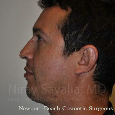 Facelift Before & After Gallery - Patient 1655678 - After