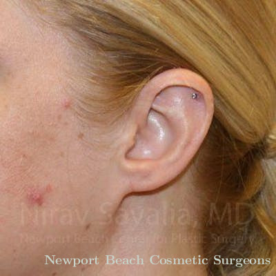 Facelift Before & After Gallery - Patient 1655679 - After