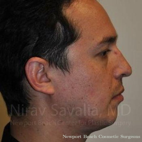 Fat Grafting to Face Before & After Gallery - Patient 1655678 - Before