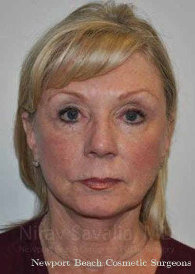 Facelift Before & After Gallery - Patient 1655681 - After