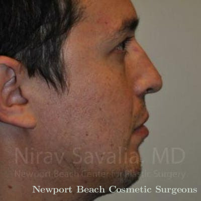 Chin Implants Before & After Gallery - Patient 1655678 - After