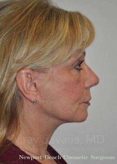 Mastectomy Reconstruction Revision Before & After Gallery - Patient 1655682 - After