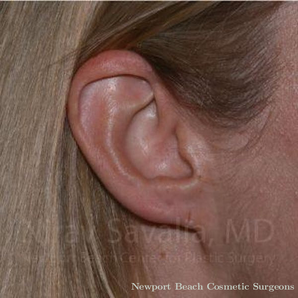 Torn Earlobe Repair Ear Gauge Repair Before & After Gallery - Patient 1655679 - Before