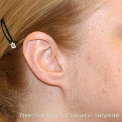 Torn Earlobe Repair Ear Gauge Repair Before & After Gallery - Patient 1655679 - After