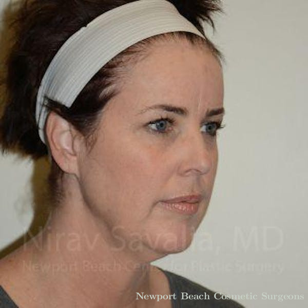 Fat Grafting to Face Before & After Gallery - Patient 1655683 - Before
