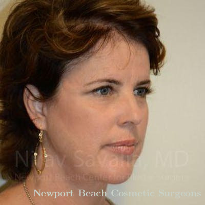 Mastectomy Reconstruction Revision Before & After Gallery - Patient 1655683 - After