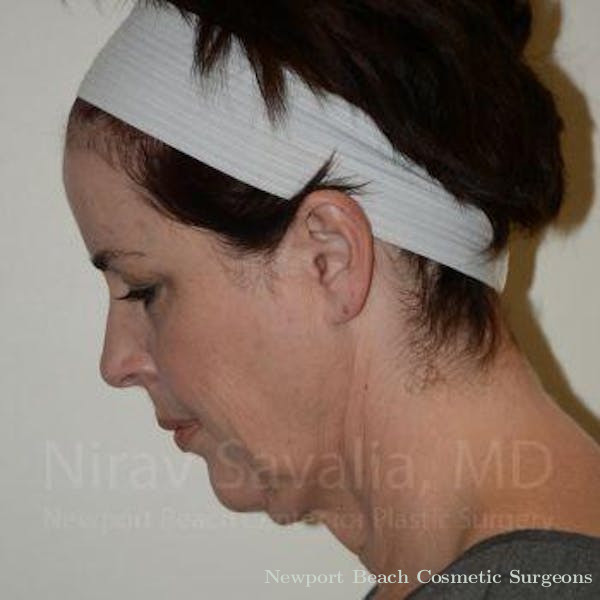 Oncoplastic Reconstruction Before & After Gallery - Patient 1655683 - Before