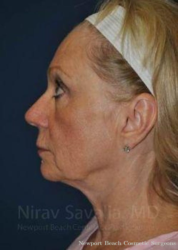 Facelift Before & After Gallery - Patient 1655682 - Before