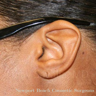 Torn Earlobe Repair Ear Gauge Repair Before & After Gallery - Patient 1655684 - Before