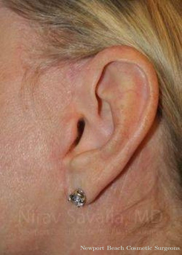 Torn Earlobe Repair Ear Gauge Repair Before & After Gallery - Patient 1655682 - Before