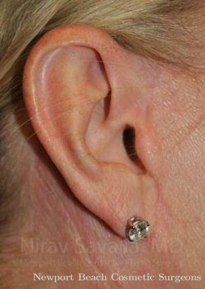 Torn Earlobe Repair Ear Gauge Repair Before & After Gallery - Patient 1655681 - After