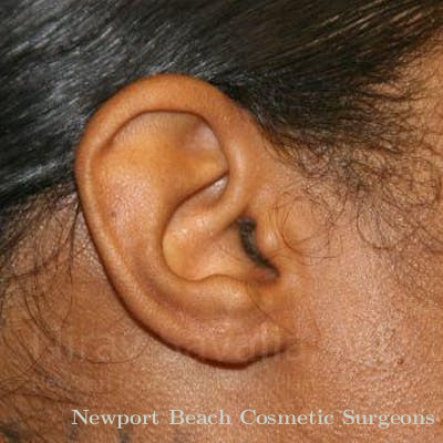 Torn Earlobe Repair Ear Gauge Repair Before & After Gallery - Patient 1655684 - After