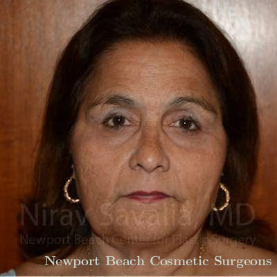 Brow Lift Before & After Gallery - Patient 1655687 - After