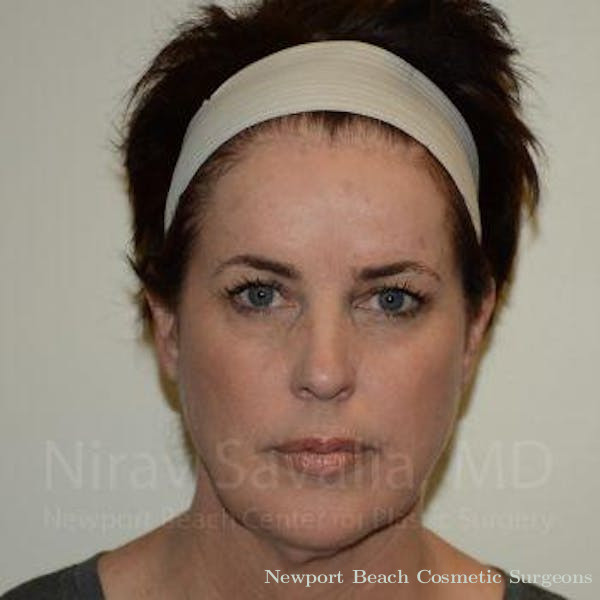 Liposuction Before & After Gallery - Patient 1655689 - Before