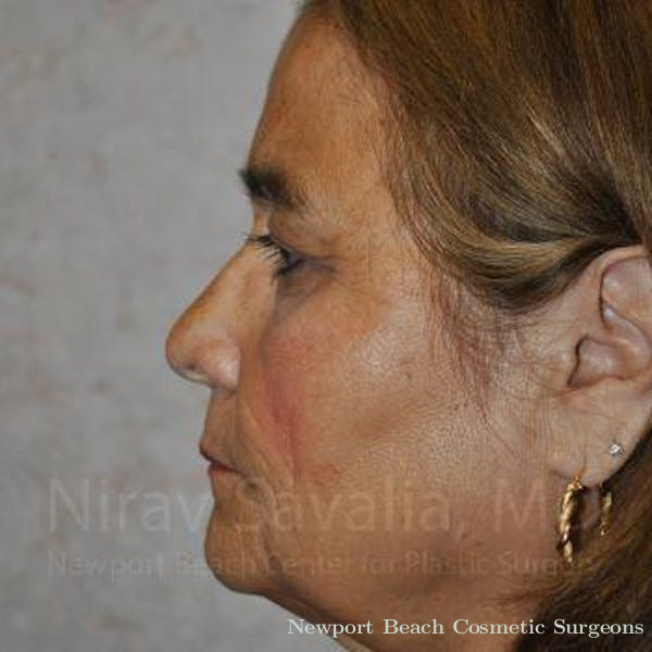 Torn Earlobe Repair Ear Gauge Repair Before & After Gallery - Patient 1655687 - Before
