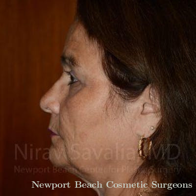 Breast Explantation En Bloc Capsulectomy Before & After Gallery - Patient 1655687 - After