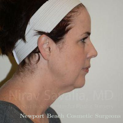Facelift Before & After Gallery - Patient 1655689 - Before