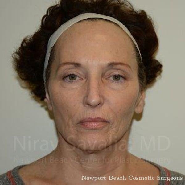 Fat Grafting to Face Before & After Gallery - Patient 1655690 - Before