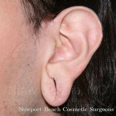 Torn Earlobe Repair Ear Gauge Repair Before & After Gallery - Patient 1655686 - Before