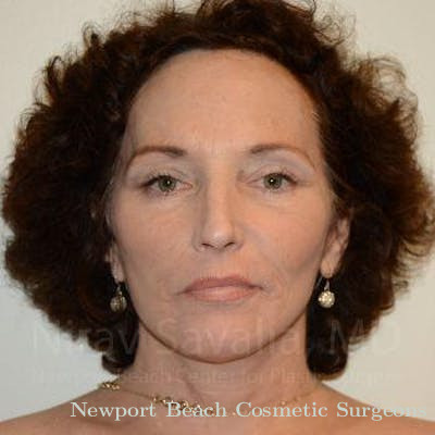 Facelift Before & After Gallery - Patient 1655690 - After