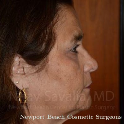 Mastectomy Reconstruction Before & After Gallery - Patient 1655687 - After