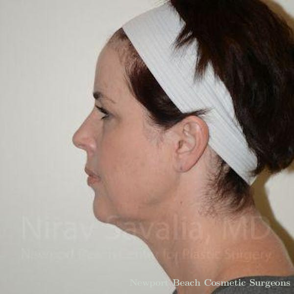 Oncoplastic Reconstruction Before & After Gallery - Patient 1655689 - Before