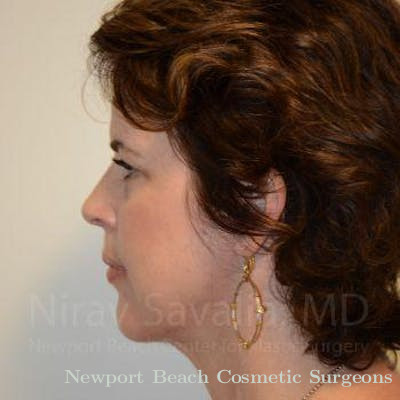 Chin Implants Before & After Gallery - Patient 1655688 - After