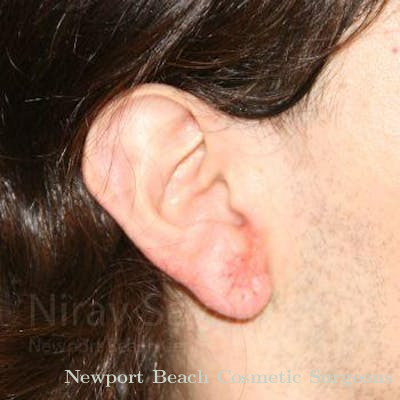 Torn Earlobe Repair Ear Gauge Repair Before & After Gallery - Patient 1655686 - After