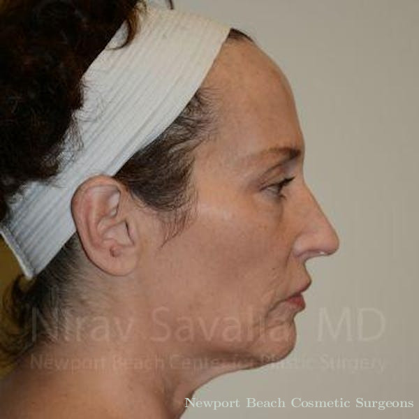 Facelift Before & After Gallery - Patient 1655690 - Before
