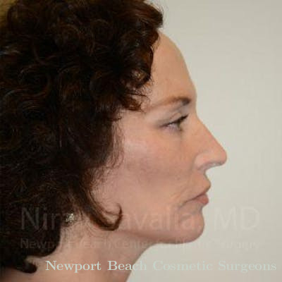 Chin Implants Before & After Gallery - Patient 1655690 - After