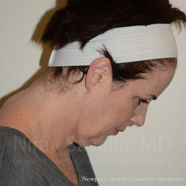 Facelift Before & After Gallery - Patient 1655688 - Before