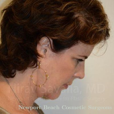 Facelift Before & After Gallery - Patient 1655689 - After