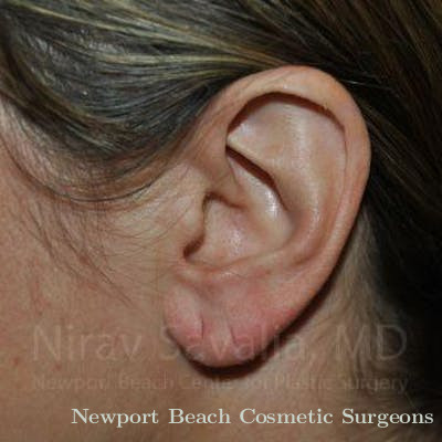 Torn Earlobe Repair Ear Gauge Repair Before & After Gallery - Patient 1655691 - Before