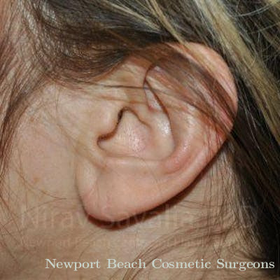 Torn Earlobe Repair Ear Gauge Repair Before & After Gallery - Patient 1655691 - After